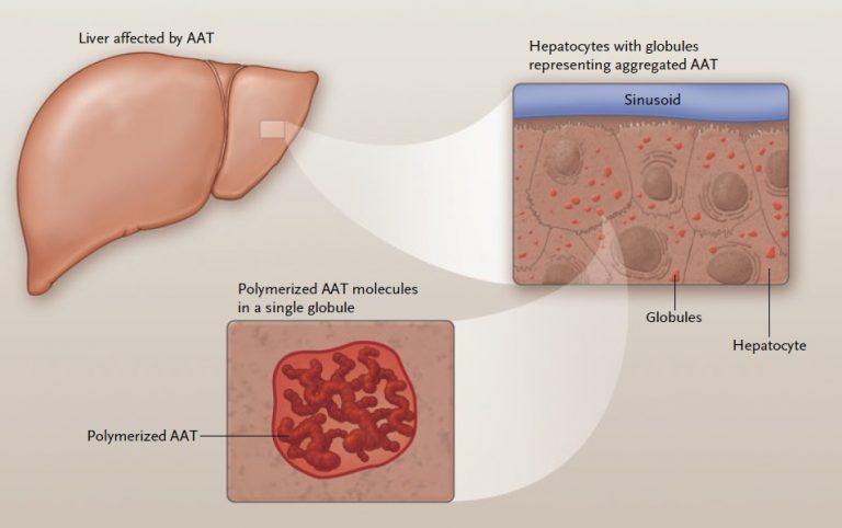 alpha-1-liver-disease-causes-treatments-and-more-alphanet